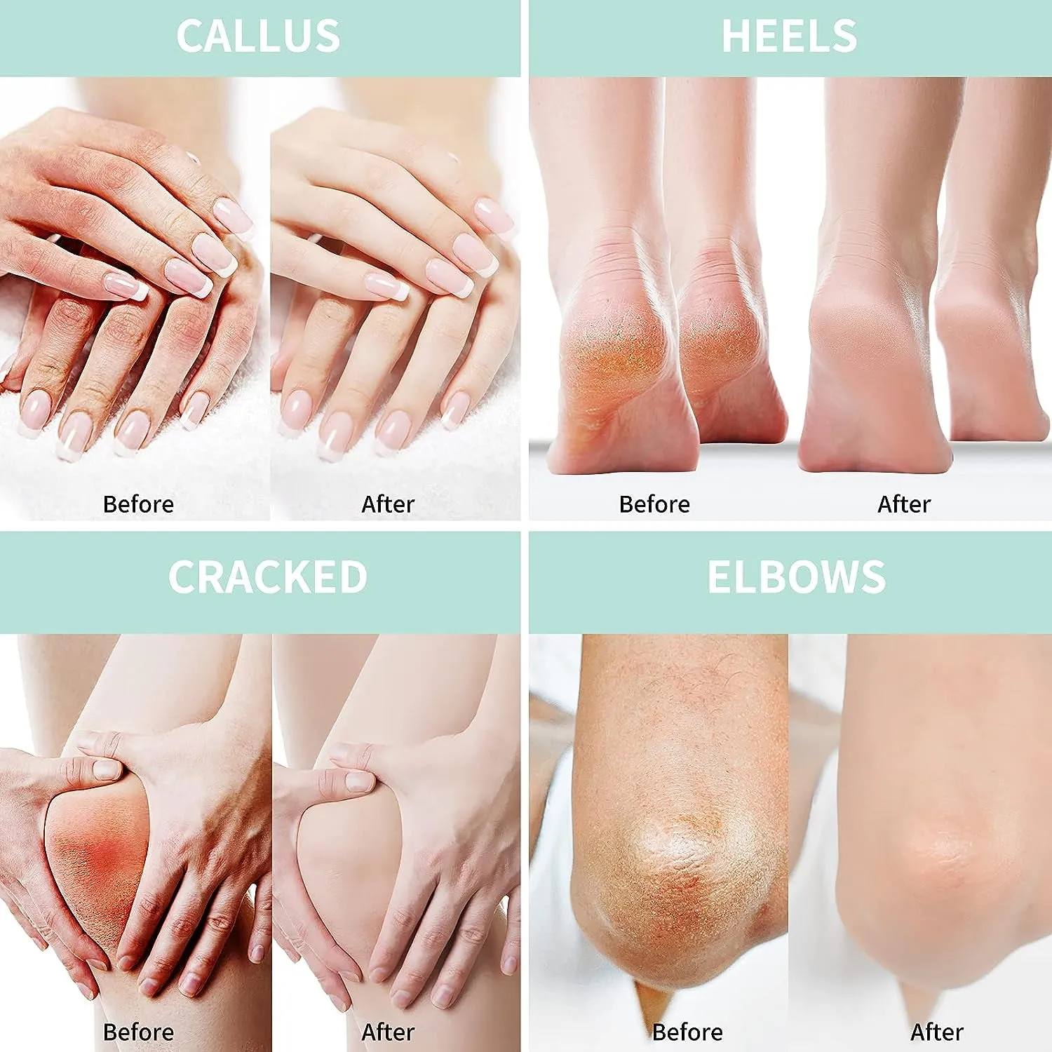 Urea Cream 40 Percent for Feet plus 2% Salicylic Acid 5.29 Oz || Foot Cream and Hand Cream Maximum Strength with Hyaluronic Acid,Tea Tree,And Aloe Vera for Deep Moisturizes,Callus Remover